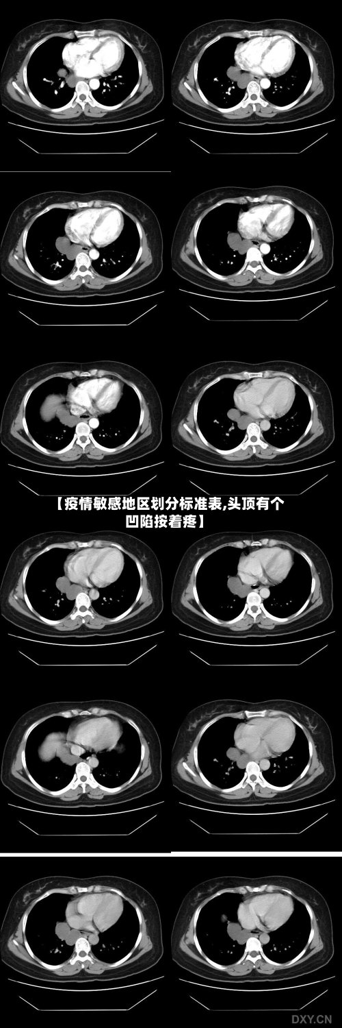【疫情敏感地区划分标准表,头顶有个凹陷按着疼】